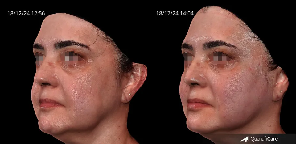 Fios de sustentação antes e depois resultado 10