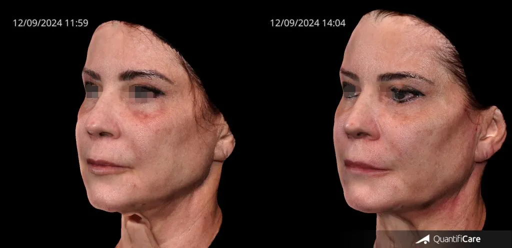 Fios de sustentação antes e depois resultado 7