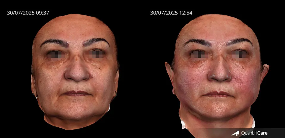 Fios de sustentação antes e depois resultado 3