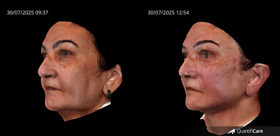 Fios de sustentação antes e depois resultado 4