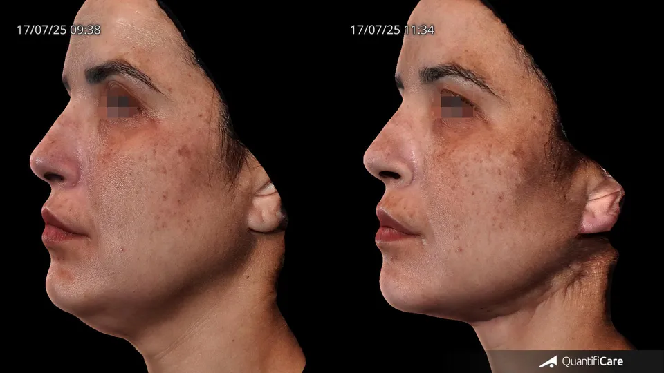 Fios de sustentação antes e depois resultado 8