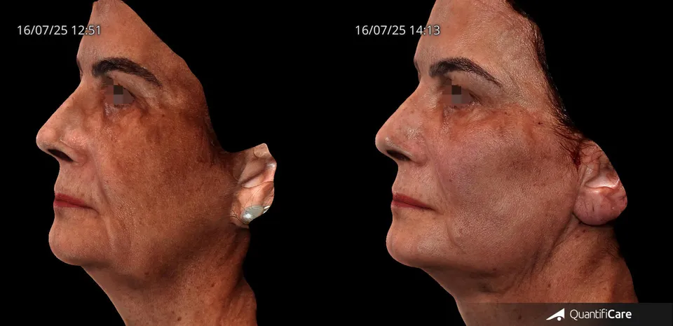 Fios de sustentação antes e depois resultado 1