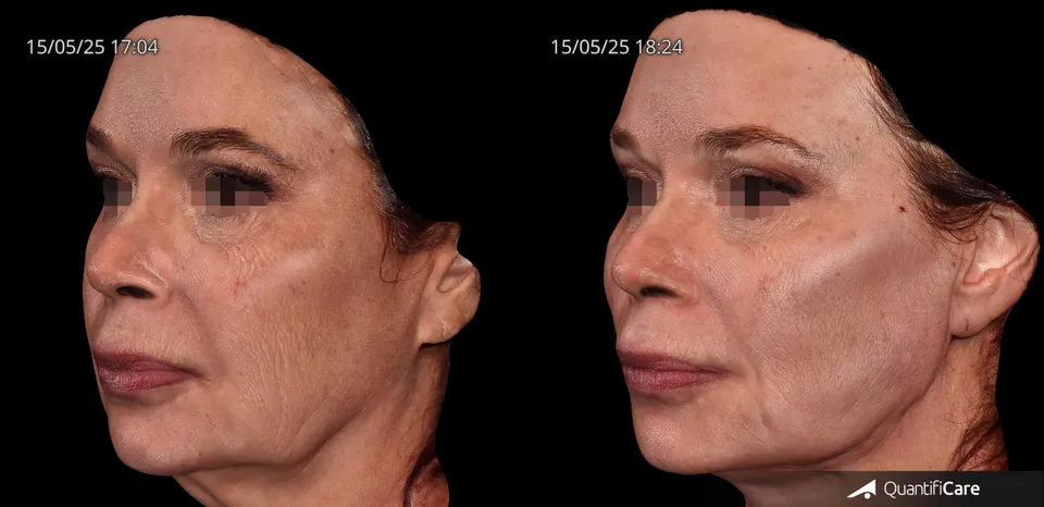 Fios de sustentação antes e depois resultado 2