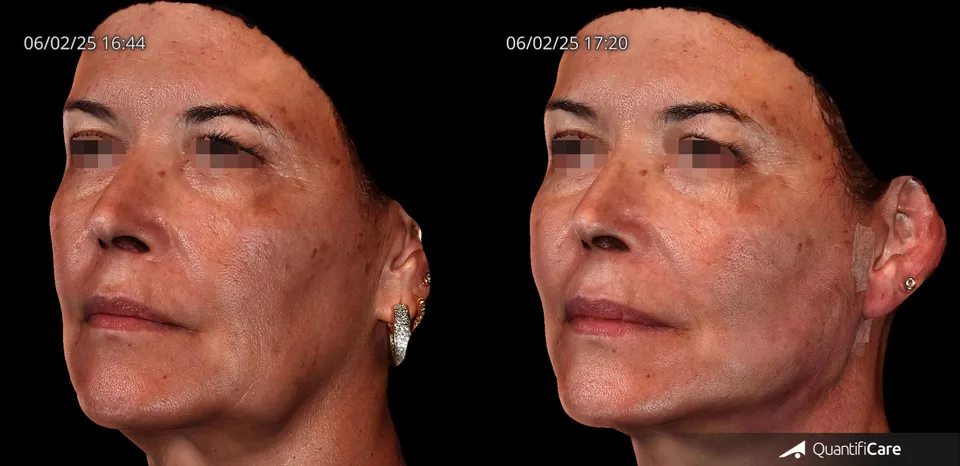 Fios de sustentação antes e depois resultado 6